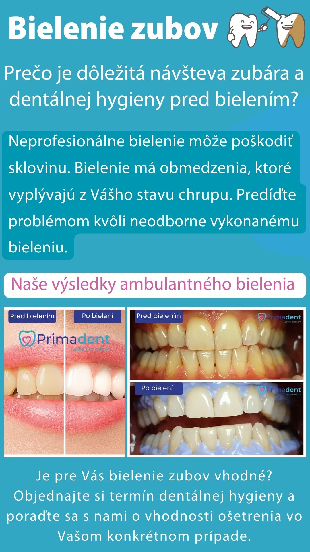 Bielenie zubov - Prečo absolvovať predtým dentálnu hygienu?